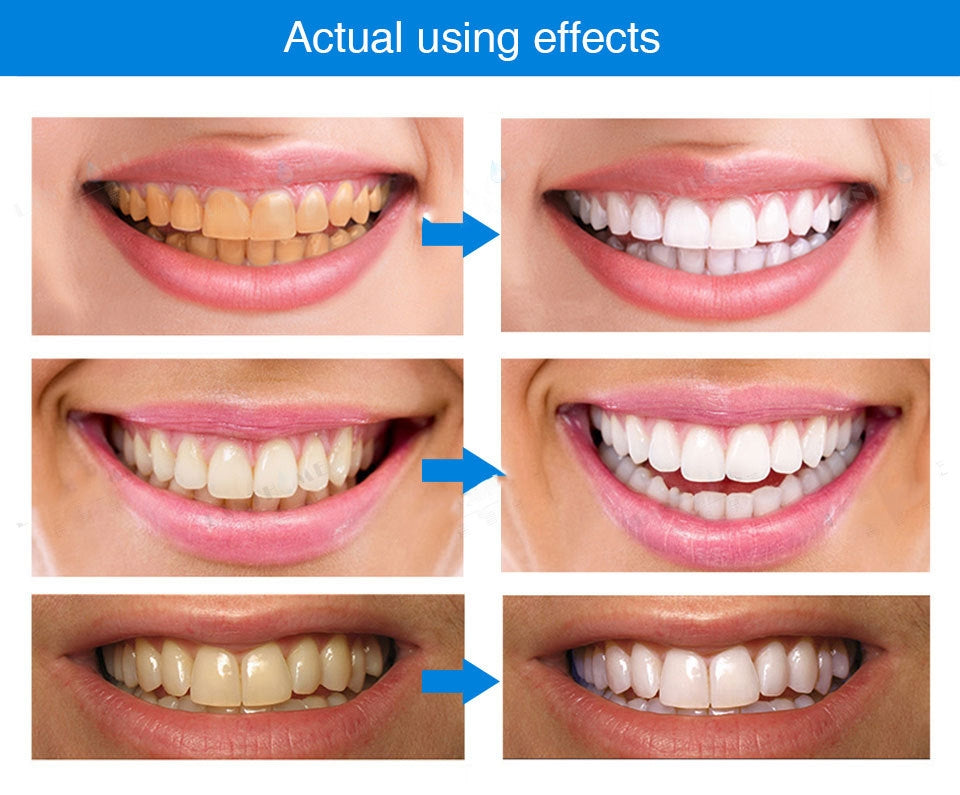 Lanthome™ Teeth Whitening Pen